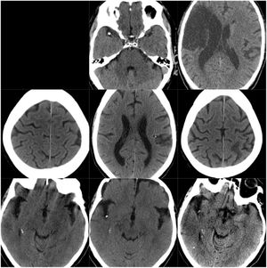 CT scans of CCE in patients 7-9. The first column shows CT scans performed prior to CCE, the second column shows images of the CCE, and the third column shows images of the corresponding stroke.