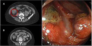 A) Abdominal CT with contrast performed at admission revealed bowel wall thickening with submucosal oedema in the ascending colon; these findings are compatible with colitis. B) Abdominal CT with contrast performed at discharge, showing resolution of inflammatory signs. C) Colonoscopy image showing fibrinated ulcerations in the transverse colon.