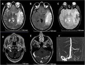 Brain MRI and MRI angiography. A and B) Hyperintense lesion on T2-weighted and FLAIR sequences compatible with venous haemorrhagic infarction. C) Echo-gradient sequence showing haemosiderin deposits. D and E) Post-contrast T1-weighted sequence revealing obstruction of the left jugular vein and left venous sinuses. F) Brain MRI angiography revealed venous sinus thrombosis of the left sigmoid and left transverse sinuses and torcula.