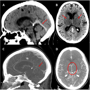 Baseline head CT scan. A) Hyperdensity of the straight sinus. B) Bilateral capsuloganglionic and thalamic infarcts. Contrast-enhanced CT angiography, venous phase. C) Lack of opacification of the straight sinus. D) Poor opacification of the deep venous system, predominantly on the left side.