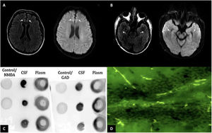 (A) MRI of the brain in T2 FLAIR and diffusion-weighted imaging showing hyperintensities in the bilateral anterior cingulate cortex and (B) bilateral temporal lobes (white arrows). (C) Dot blot (1:1,000 dilution); revealing positivity for the presence of GAD65 and NMDA antigens in the CSF. (D) Tissue-based assay in CSF with direct immunofluorescence showing intracellular and cell-surface antigens (GAD65, NMDA).