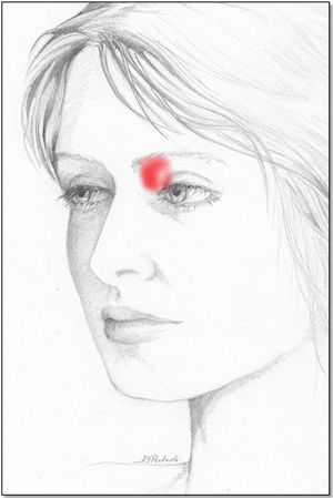 Painful area described by patients with involvement of the trochlear region.