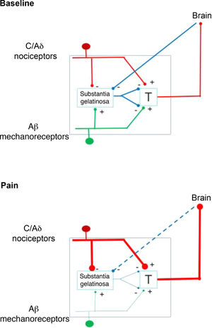 Explanation of the gate control theory of pain. Left: state of equilibrium; right: during perception of pain. T: first central transmission.