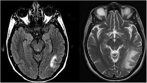 Left: MRI sequence showing a T2-hyperintense lesion in the left temporo-occipital region at the time of diagnosis of PML. Right: MRI study at 2 months (when IRIS was diagnosed), revealing growth of the lesion and perilesional oedema.