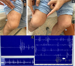 A) Bilateral suprapatellar depression, more marked in the right knee. B) Amyotrophy of the tibialis anterior and quadriceps muscles, with inability to extend both knees. C) Needle electromyography of the right vastus lateralis muscle, showing reduced motor unit potentials interspersed with polyphasic motor unit potentials, and a pattern of reduced maximal effort.