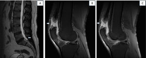 Lumbar spine and knee MRI (T2-weighted sequence, sagittal plane). A) Lumbar spine MRI revealing a small protrusion at L5-S1, and a smaller one at L4-L5. B) Right knee MRI revealing rupture of 90% of the fibres of the quadriceps tendon. C) Left knee MRI revealing full-thickness rupture of the quadriceps tendon.