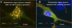 Immunocytochemistry images showing the distribution of tyrosine hydroxylase (TH) and α-synuclein (αSYN) in a culture of dopaminergic neurons from the substantia nigra, treated with 10μM of 3-iodo-L-tyrosine (A) or vehicle solution (B). (A) The cells present numerous round inclusions expressing both αSYN and TH, hence the light colouration. Numerous aggregates are observed surrounding the nucleus. (B) A neuron treated with vehicle solution, displaying diffuse light signal mainly in the soma, with darker signal for TH in the neurites. In other words, the expression of both proteins is diffuse in the soma, with TH expression being more intense in the neurites. The sample does not present inclusions like those shown in panel A. The nucleus was stained with DAPI. N: nucleus. Source: taken from Fernández-Espejo.26 Copyright © 2018, Fisiología, journal of the Spanish Society of Physiological Sciences.