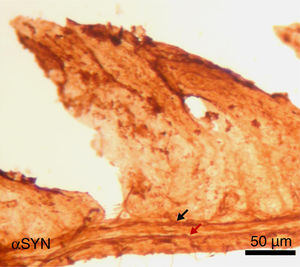 Image of the jejunal wall after immunohistochemistry staining for α-synuclein (αSYN); sample taken from a mouse treated with 4 weekly intraperitoneal injections of 10μM 3-iodo-L-tyrosine. The Meissner plexus and Auerbach plexus (arrows) are positive for αSYN, and present thickening, with aggregates of the protein. These findings were not observed in control mice, in which these plexi were thin and expressed little αSYN.