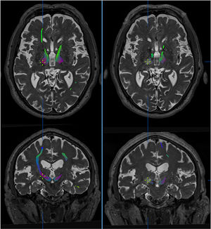 Effect of thalamotomy by ultrasound (MRgFUS) on the dentatorubrothalamic tract (DRTT). Tractography images of the DRTT from high-field diffusion tensor MRI sequences (Skyra, 3 T, Siemens), before (left) and after treatment (right). The DRTT is observed in the thalamus at the intercommissural level. Axial and coronal slices show the virtual disappearance of the tract in the post-treatment sequences, with the contralateral tract persisting. The cursor indicates the location of the lesion. Images extracted from Brainlab’s iPlan planning software.