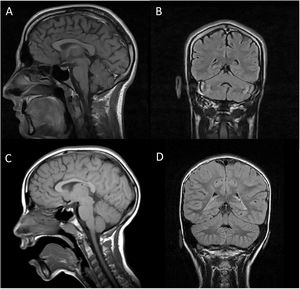Brain MRI scan of our 2 patients. A and C) T1-weighted sequence (sagittal plane). B and D) FLAIR sequences (coronal plane). Images A and B are from patient 1, and images C and D from patient 2. In both cases, MRI revealed no alterations in the brainstem or cerebellum, with absence of the typical signs of pontocerebellar hypoplasia, except for slight atrophy of the vermis in patient 1.