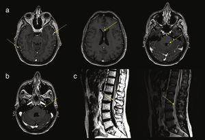 (a) Several axial slices from a contrast T1-weighted MRI sequence, showing enhancement and thickening of the dura mater and leptomeninges, periventricular enhancement, and nodular enhancement of the fourth ventricle. (b) Contrast T1-weighted brain MRI scan showing enhancement of the left acoustic-facial bundle. (c) Contrast T1- and T2-weighted sagittal MRI scan of the lumbar spine, showing thickening and enhancement of the roots of the cauda equina.