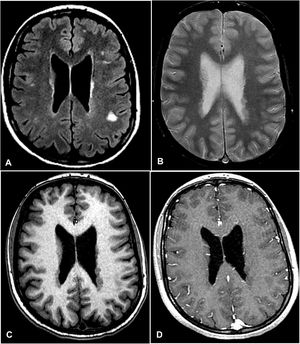 A) FLAIR sequence showing subcortical hyperintensities, some of them isointense with the cerebral cortex; these findings were also observed on the proton density–weighted sequence (B). C) T1-weighted sequence showing periventricular lesions corresponding with isointense nodular images in the cerebral cortex, without gadolinium uptake (D). The periventricular findings are highly indicative of periventricular cortical heterotopia, whereas the hyperintense subcortical lesions on FLAIR sequences present non-specific characteristics and are not conclusive for the diagnosis of multiple sclerosis.