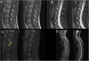 Lumbar MRI (A–C), and medullary MRI. (A) T1-weighted sequence without contrast. (B) STIR sequence. (C) T1-weighted sequence with gadolinium. (D) Medullary MRI. Left image T1 weighted sequence; right image T2-weighted sequence. The figure shows linear enhancement in conus medullaris and nerve roots (green arrow).