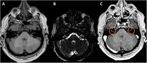 Brain MRI. (A) T1-weighted sequence. (B) Fat suppression T2-weighted sequence. (C) T1-weighted sequence with gadolinium. The figure shows millimeter enhancement of both the VII and VIII cranial nerves.