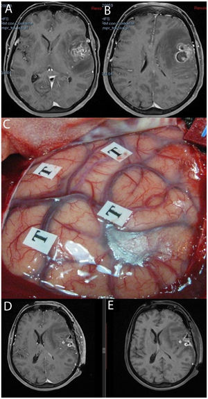 MRI study: post-contrast T1-weighted sequences (A and B) showing a tumour corresponding to glioblastoma located in the left opercular region. We performed awake surgery with intraoperative brain mapping (C). Postoperative MRI sequences with and without intravenous contrast (D and E, respectively) showed postoperative changes, with blood residue in the absence of residual tumour; the patient displayed no worsening of language.