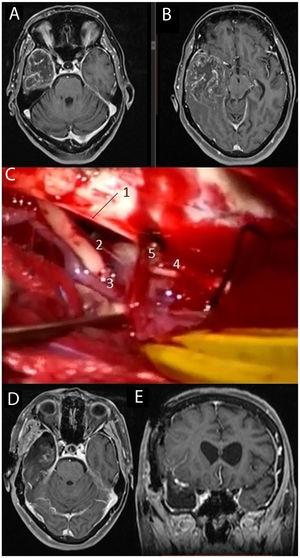 MRI study: post-contrast T1-weighted sequences (A and B) showing a large tumour corresponding to glioblastoma located in the right temporal lobe. We performed temporal lobectomy; the intraoperative image (C) shows the tentorium cerebelli free border (1), the right third cranial nerve (2), the right posterior communicating artery (3), and the right fourth cranial nerve (4) alongside a cortical vein draining into the tentorium (5). Postoperative axial and coronal MRI sequences (D and E, respectively).