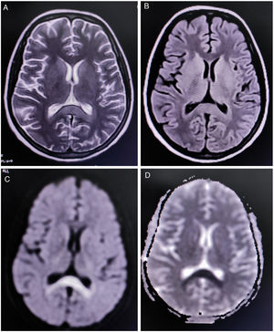MRI of the brain showing non-enhancing hypertense lesion on axial T2-weighted image (A), and axial T2-FLAIR (B), with substantial diffusion restriction on diffusion-weighted imaging (C) and ADC (D) sequences, involving the splenium of the corpus callosum, suggestive of boomerang sign.
