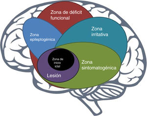 Overlap of cortical zones related to epileptic seizures.
