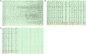 EEG recording of typical tonic-clonic seizures. A) Interictal and preictal periods. B) Ictal period. C) Ictal and postictal periods.