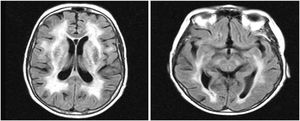 Brain MRI, T2/FLAIR sequence.