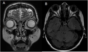 Coronal T2-weighted (A) and axial T2-FLAIR (B) MRI sequences revealing bilateral choroidal effusion with non-haemorrhagic exudates and bilateral papilloedema.