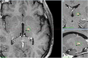 Brain magnetic resonance imaging (MRI) follow-up at 12 months. Axial, coronal, and sagittal T1-weighted sequences. Hypointense, oval-shaped, millimetric lesion showing contrast uptake.