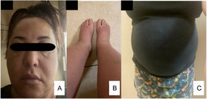 Facial edema (A), lower limbs edema (B), thorax and abdomen edema (C).