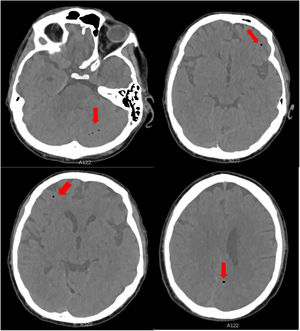 Head CT scan showing multiple air bubbles in both frontal and parietal lobes, the left temporal lobe, left cerebellar hemisphere, and both pterygopalatine fossae; these images are compatible with air embolism.