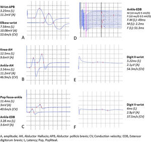 Electroneurography performed four days from clinical onset. Electrophysiological examinations of the following motor nerves (scanning speed: 2ms/D, sensitivity: 5mV/D) are shown: right median nerve (A), left tibial nerve (B), and right peroneal nerve (C); whit no remarkable findings. Right peroneal nerve F-waves showed increased latency (D). Electrophysiological examinations of sensory waves (scanning speed: 1ms/D, sensitivity: 20μV/D): both superficial peroneal nerves sensory waves were absent (not shown). Right median nerve (E), left ulnar nerve (F) and right and left sural nerves sensory wave amplitudes were decreased. Left median nerve and right ulnar nerve sensory waves were not induced. These results fulfil the electrodiagnostic criteria for acute inflammatory demyelinating polyneuropathy.