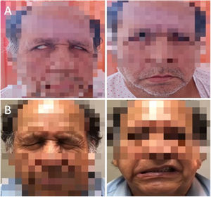 Physical examination. A) Physical examination performed during the patient’s second hospitalisation, showing bilateral facial paralysis affecting both the upper and lower face. B) Physical examination performed by the rehabilitation department one month after discharge, showing persistent right lower facial paresis.