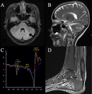Neuroimaging features. Axial (A) and Sagittal (B) T2 Flair images display bilateral hyperintensity of the dentate nucle (black arrow). MRS (C) revealed increased lipid and lactate peaks and decreased choline and N-acetyl aspartate peaks in bilateral cerebellar dentate nucleus. Left ankle MRI PD-weighted images (D) display uneven hyperintensity of the left Achilles tendon.