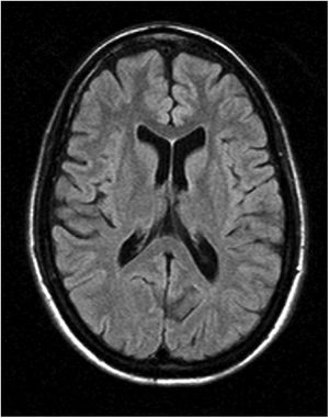 Brain MRI scan.