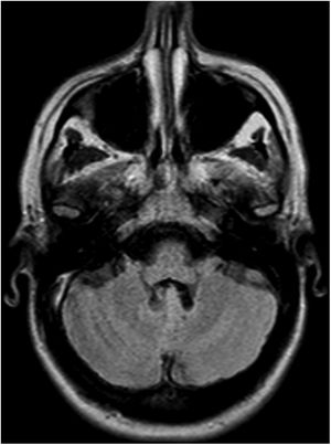 Cerebellar MRI scan.