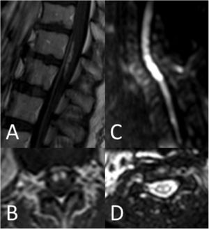 Spinal cord MRI findings. A and B) Gadolinium uptake (sagittal and axial planes). C and D) Diffusion restriction on DWI sequences (sagittal and axial planes).
