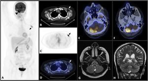 A maximum intensity projection (MIP) PET image (A) shows increased 18 F-fluorodeoxyglucose (FDG) uptake in right cerebellum (SUV max:20) (arrowhead) and left axillary lymph node (SUV max:7) (arrow). Axial thorax CT (B), PET (C), and fusion PET-CT (D) images reveal increased FDG uptake in left axillary lymph node. Fusion PET-CT images of brain (E, F) demonstrate increased FDG uptake in right cerebellum. T2W coronal (G) and axial (H) brain MR imaging show no features.