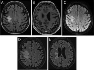Brain MRI study. Axial slices from FLAIR (A), gadolinium-enhanced T1-weighted (B), and diffusion-weighted sequences (C) at the time of the patient’s first admission, showing altered signal in the right perirolandic area, extending to the centrum semiovale. The lesion presents no contrast enhancement, and appears hyperintense on the diffusion-weighted sequence. Two months later (D), the initial lesion had increased in size, extending to the corpus callosum and internal capsule; small satellite lesions were also visible in the adjacent white matter (E).
