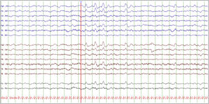Baseline EEG study. The study was performed with the patient awake, calm, and with her eyes closed. Setup: longitudinal bipolar montage, LFF 0.5 Hz, HFF 30 Hz, sensitivity 10 μV/mm, timebase 15 mm/s. EEG reveals normal background activity with frontal intermittent rhythmic delta activity, both in isolation and in trains lasting several seconds (red line).