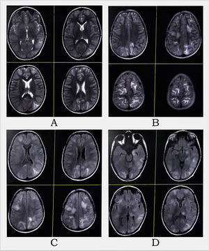 MRI of the brain revealed multifocal altered intensity lesions, hyperintense on T2-WI (A and B) and T2-FLAIR (C and D) at regions of both frontal, parietal, and occipital lobes; left temporal lobe, and left thalamus, mostly involving cortical and subcortical U-fibers with mass effect over adjoining sulci.