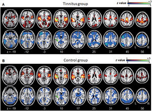 Averaged left A1-based functional connectivity maps of the (A) tinnitus and (B) control groups. The first row represents the positive correlation between the left A1 and whole brain, whereas the second row represents the negative correlation between the left A1 and whole brain. The hot colormap represents the brain areas that positively correlate with the left A1, whereas the winter colormap represents the brain areas that negatively correlate with the left A1. For visualization, the left A1-based connectivity maps of all patients or all controls are averaged and thresholded by the z value of |1|. The green area indicates the seed region. The connectivity between the left A1 and bilateral superior, middle, and medial frontal areas, middle and inferior temporal areas, inferior parietal areas, and subcortical areas as well as the right inferior parietal lobule is significantly negative in the tinnitus group (winter colormap in A) and not in the control group (gray color in B). The connectivity between the left A1 and bilateral somatosensory areas (winter colormap in A and B, z=25 and 31) is positive in both groups, but stronger in patients with tinnitus.