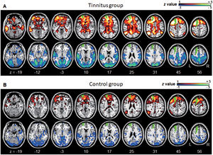 Averaged left DLPFC-based connectivity maps of the (A) tinnitus and (B) control groups. The first row represents the positive correlation between the left DLPFC and whole brain, whereas the second row represents the negative correlation between the left DLPFC and whole brain. The hot colormap represents the brain areas that positively correlate with the left DLPFC, whereas the winter colormap represents the brain areas that negatively correlate with the left DLPFC. For visualization, the left DLPFC-based connectivity maps of all patients or all controls are averaged and thresholded by the z value of |1|. The green area indicates the seed region. The tinnitus group (A) showed significantly positive (hot colormap in top row) and negative (winter colormap in bottom row) DLPFC connectivity with more extensive areas compared with the control group (B).