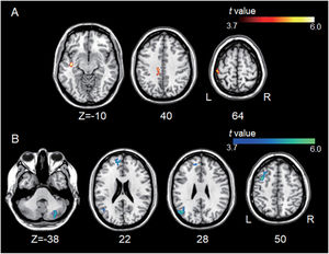 Group differences between left A1-based connectivity maps. (A) The hot colormap represents the brain areas with significantly increased positive connectivity of the left A1 in the tinnitus group compared with the control group. These regions include the left middle temporal, cingulate, and postcentral areas. (B) The winter colormap represents the brain areas with significantly increased negative connectivity of the left A1 in the tinnitus group compared with the control group. These regions include the left superior, middle, and medial frontal and angular areas and right cerebellar areas.