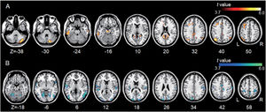 Group differences between the left DLPFC-based connectivity maps. (A) The hot colormap represents the brain areas with significantly increased positive connectivity in the tinnitus group compared with the control group. The regions include the bilateral posterior cingulate cortex, parahippocampal areas, and midbrain, right cerebellum, bilateral angular areas extending to the precuneus, middle temporal area, inferior parietal lobule, and inferior temporal areas, and left frontal and anterior cingulate areas. (B) The winter colormap represents the brain areas with significantly increased negative connectivity in the tinnitus group compared with the normal group. The regions include bilateral temporo-occipital, parietal (e.g., the precuneus and postcentral and inferior parietal lobules), cingulate, and cerebellar areas.