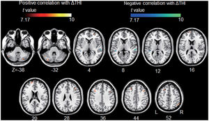 Association between tinnitus improvement (ΔTHI) and the left A1-based connectivity maps of the tinnitus group. The hot colormap represents the positive correlation between the ΔTHI and left A1-based connectivity maps. The winter colormap represents the negative correlation between the ΔTHI and left A1-based connectivity maps. Tinnitus improvement was estimated by subtracting the pre-rTMS THI scores from the post-rTMS THI scores. Thus, a low ΔTHI (hot colormap) indicates a good rTMS outcome, whereas a high ΔTHI (winter color map) indicates a poor rTMS outcome. An rTMS outcome is poor when the connectivity between the left A1 and bilateral frontal cortices is similar to that of the control subjects (i.e., stronger connectivity [hot colormap]). An rTMS outcome is good when the connectivity between the left A1 and bilateral temporal cortices is strong (winter color map).