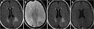 Brain MRI findings from patient 6. The patient was an 83-year-old woman with acute symptoms of disorientation, confusion, and seizures. Brain MRI shows bilateral involvement of parietal white matter, predominantly affecting the left side (A). Susceptibility-weighted sequences (B) revealed multiple cortical microbleeds at the posterior edge of both parietal lobes; leptomeningeal contrast uptake within the sulci was more clearly identified on FLAIR sequences (C) than on post-contrast T1-weighted sequences (D).