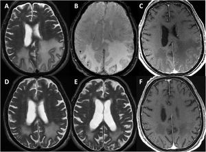 Radiological progression of patient 1 (an 81-year-old man). Brain MRI revealed extensive bilateral parietal white matter involvement on T2-weighted sequences; involvement was asymmetrical, with a significant mass effect in the left hemisphere (A). White matter involvement coincided with multiple cortical microbleeds on susceptibility-weighted sequences (B) and predominantly left-sided leptomeningeal contrast uptake (C). Follow-up MRI studies performed at one month (D) and 3 months after corticosteroid treatment revealed a marked improvement of white matter involvement (E), with resolution of the mass effect and meningeal uptake (F).