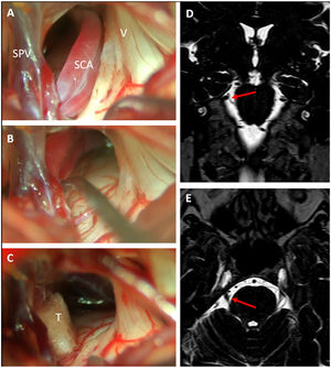 Right trigeminal neuralgia caused by a descending loop of the superior cerebellar artery (SCA) as seen on preoperative coronal (D) and axial (E) DRIVE-MRI sequences. Microsurgical inspection revealed a double arterial loop corresponding to the superior and inferior branches of the SCA compressing the superomedial portion of the trigeminal nerve (A). After dissection of the arachnoid adhesions, the arteries could be transposed cranially (B) and held in place with a Teflon pledget (C). SPV: Superior petrosal vein; SCA: Superior cerebellar artery; V: Fifth cranial nerve; T: Teflon pledget.