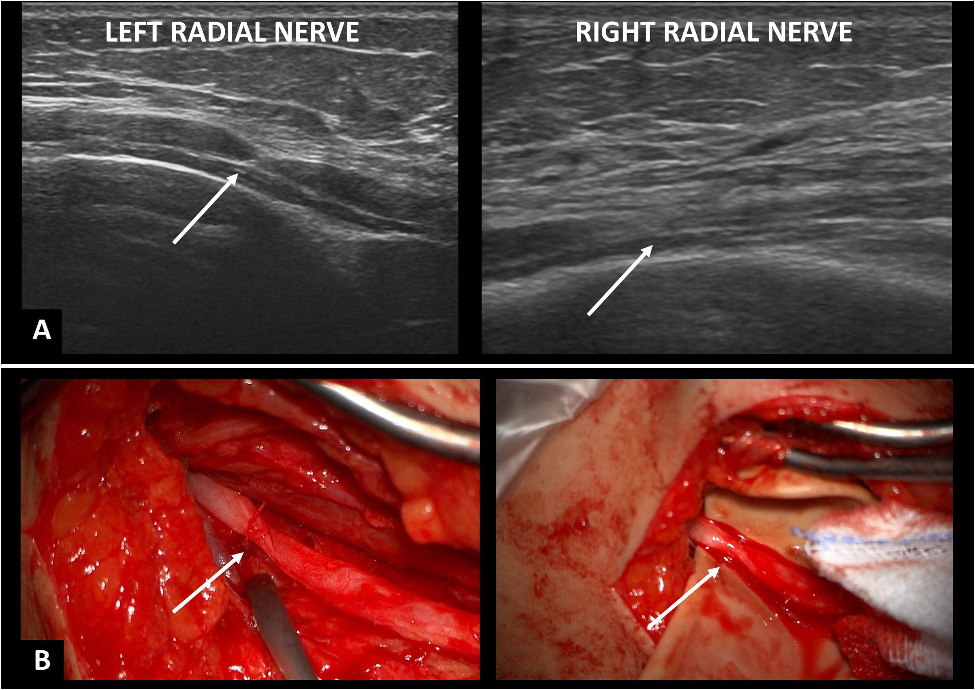 Neuralgic amyotrophy with bilateral radial nerve torsion: A unique case ...