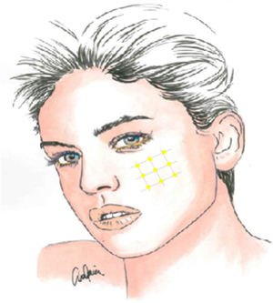 Target area for botulinum toxin infiltration in trigeminal neuralgia.
