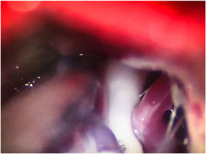 Intraoperative microscopy image of a grade III neurovascular conflict (groove on nerve) between the superior cerebellar artery and the root entry zone; image taken during a microvascular decompression procedure in a patient with refractory trigeminal neuralgia affecting the V2 branch (Hospital de la Santa Creu i Sant Pau).