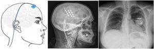 Diagram and radiography images of the skull (sagittal plane) showing the location of the motor cortex stimulation electrode plate and the subclavicular generator in a patient with trigeminal neuralgia refractory to pharmacological treatment, thermocoagulation of the Gasserian ganglion, percutaneous balloon compression, and microvascular decompression (Hospital de la Santa Creu i Sant Pau).